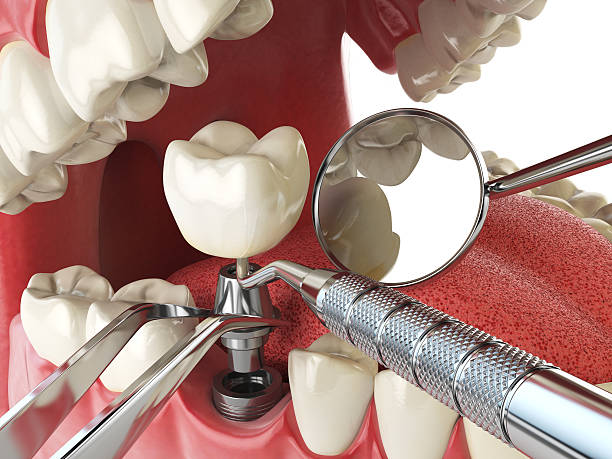 Best Emergency Wisdom Teeth Removal in North Palm Beach, FL